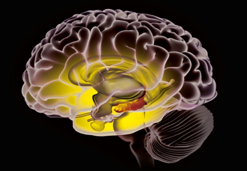 Hjerne med alzheimer