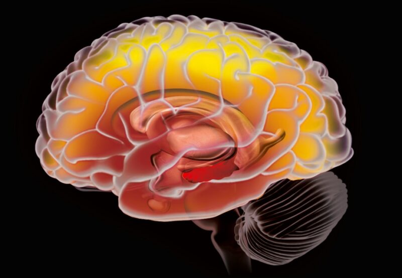 Hjerne med alzheimer