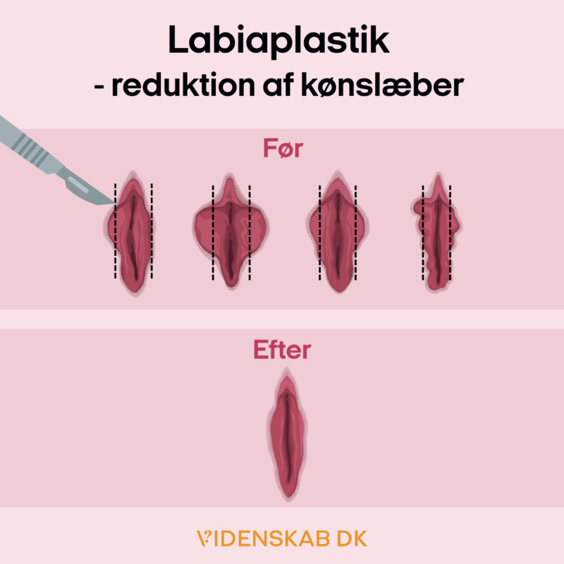 Illustration, der viser labiaplastik – reduktion af kønslæber (labiaplastik – reduktion af labia). Den viser tre før-billeder med stiplede snitlinjer og et efter-billede af reducerede kønslæber.